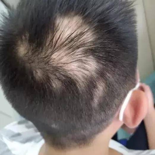 明星斑秃背后的秘密探寻